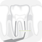 Instrument_R2LD_-_Tooth_illustration_Image_001135_00_150dpi.jpg Instrument_R2LD_-_Tooth_illustration_Image_001135_00_150dpi.jpg
