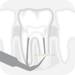 Instrument_R4LD_-_Tooth_illustration_Image_001138_00_150dpi.jpg Instrument_R4LD_-_Tooth_illustration_Image_001138_00_150dpi.jpg