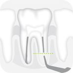 Instrument_R2RD_-_Tooth_illustration_Image_001134_00_150dpi.jpg