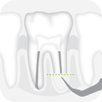 Instrument_R4RD_-_Tooth_illustration_Image_001137_00_150dpi.jpg Instrument_R4RD_-_Tooth_illustration_Image_001137_00_150dpi.jpg